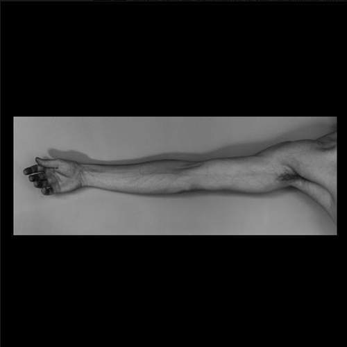 Robert Mapplethorpe, Arm (Self-Portrait), 1976.